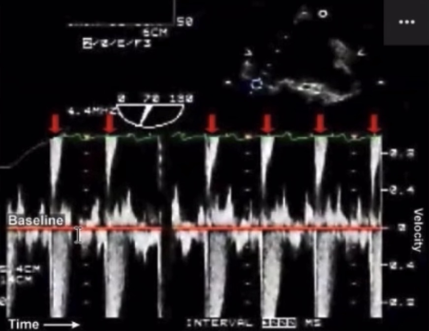 <p><span><span>What spectral Doppler artifacts are noted in this cardiac evaluation? How would you optimize the image?</span></span></p>