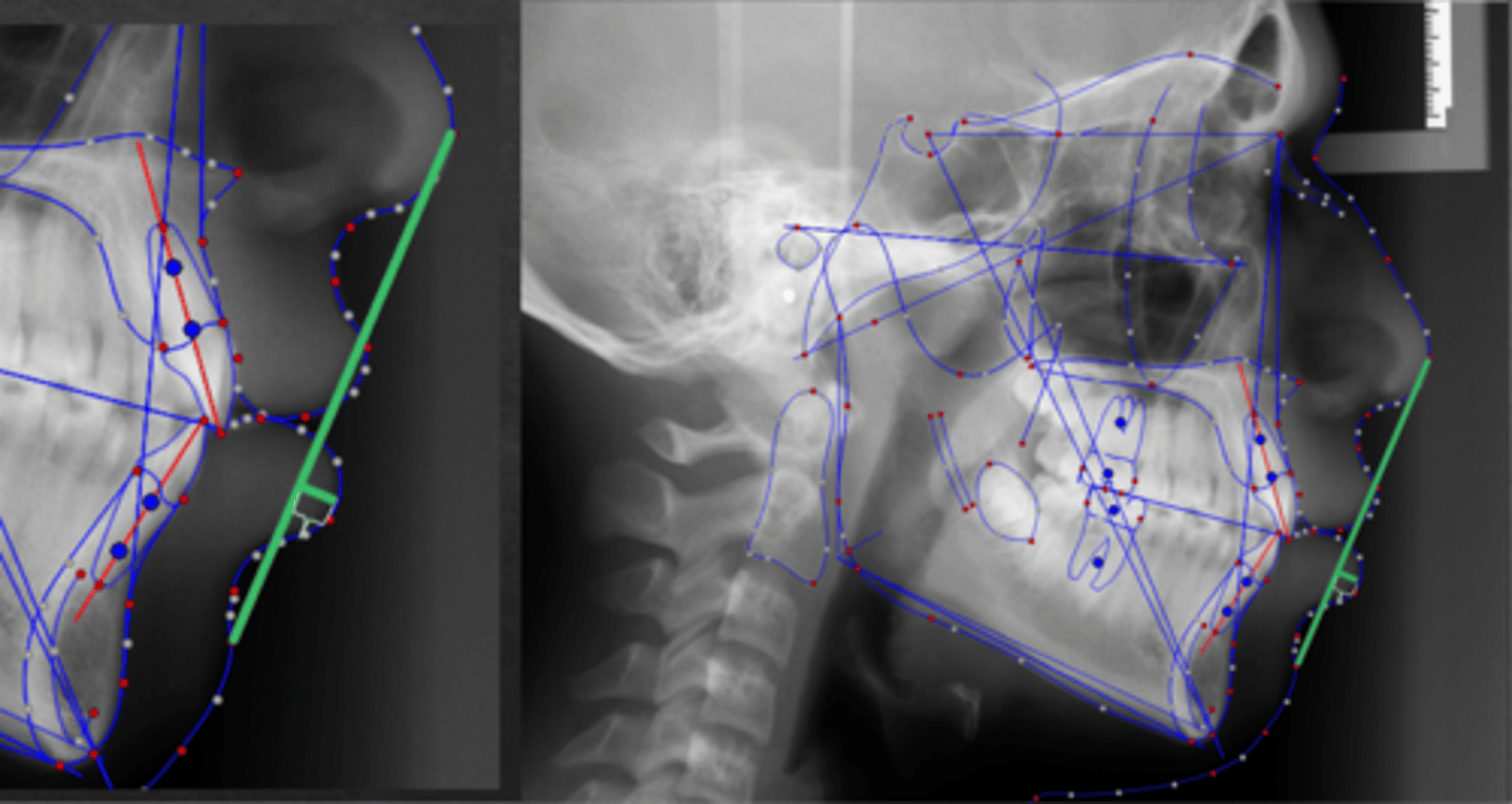 <p>what soft tissue measurement:</p><p>- Lower lip to E-Plane</p><p>- Distance from the most protrusive point on the lower lip to E-Plane along a perpendicular line</p><p>- If L Lip is anterior to E-Plane, the measurement is positive</p><p>- If L Lip is posterior to E-Plane, the measurement is negative</p><p>- Tells you about lower lip protrusion</p>