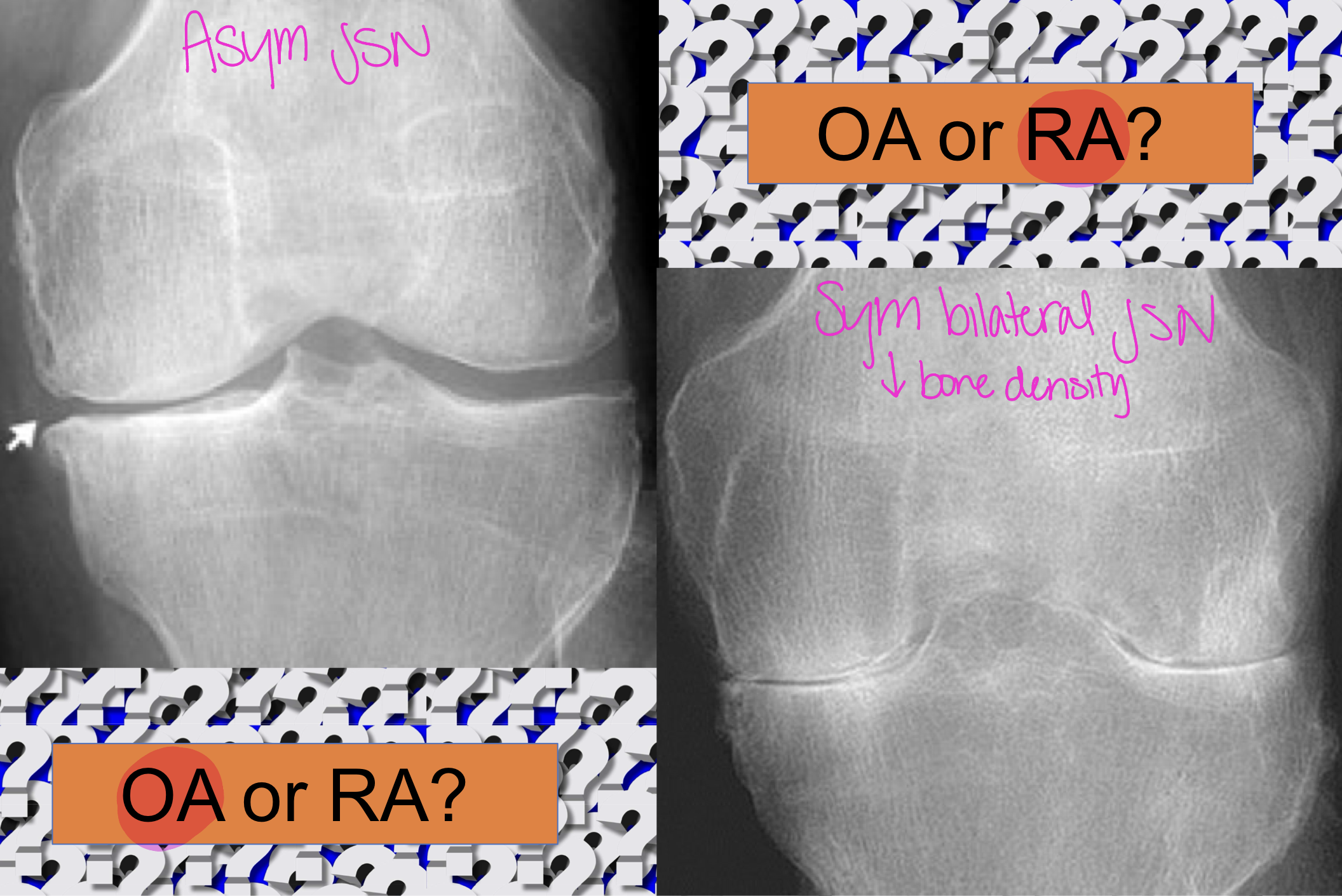 <p>OA or RA (left vs right)</p>