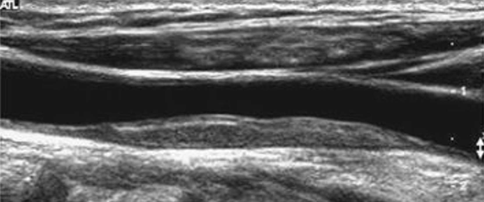 <p><span style="background-color: transparent;">In the following sonographic image, how would you describe the plaque?</span></p>
