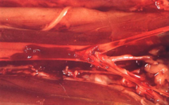 <p>What is the specific type of thromboembolism that can occur as a complication to HCM and left atrial thrombus in cats?</p>