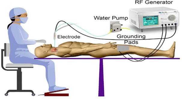 <p>RF Gen → RF cable & cath → patient → grounding pad/indifferent electrode</p>