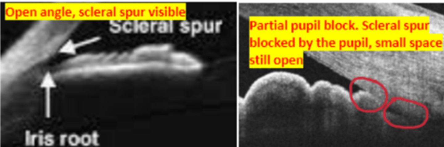 <p>Anterior segment imaging measures the anterior chamber depth by locating the trabecular meshwork as being _____ microns anterior to the scleral spur demarcated by the person performing the test</p>