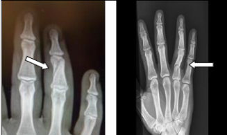 <p>M. Phalangeal Fracture</p>