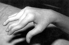 <p>Result from contracture of intrinsic muscles with dorsal subluxation of lateral extensor tendon. Observe deformity is flex of MCP & DIP along with ext. of PIP. Occurs with rheumatoid arthritis following degeneration of lateral extensor tendon</p>