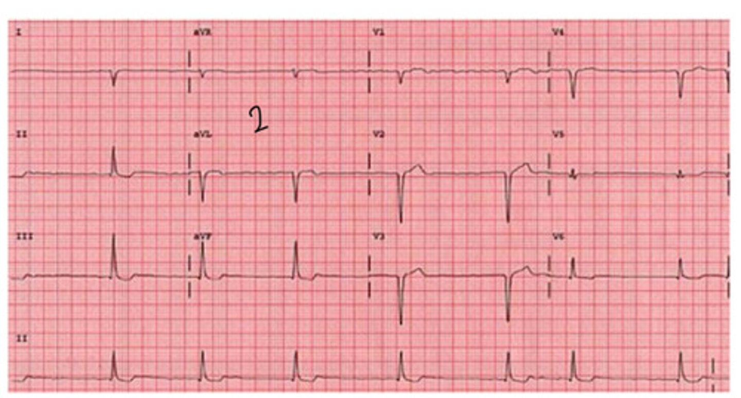 <p>is this normal, left, or right axis deviation? why</p>