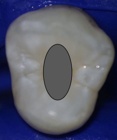 <p>Outline access shape of maxillary 1st premolar</p>