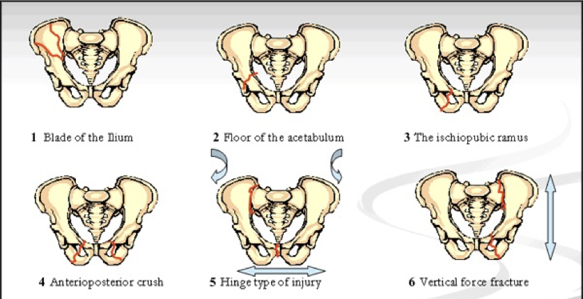 <p>What does this refer to</p><ul><li><p>Hemodynamically stable patient (NO PLAIN FILM IMAGE OF PELVIS)</p><ul><li><p>Glasgow coma scale >13</p></li><li><p>No pelvic, abdominal, or back complaints</p></li><li><p>No tenderness in the lower abdomen, lower back, groin, or bony pelvis </p></li></ul></li><li><p>Hemodynamically unstable patient</p><ul><li><p>FAST</p></li><li><p>Plain film x-ray of pelvis</p></li></ul></li><li><p>Physical examination findings indicating retrograde urethrogram BEFORE FOLEY</p><ul><li><p>Blood at the urethral meatus</p></li><li><p>High riding prostate</p></li><li><p>Gross hematuria</p></li></ul></li></ul><p></p>