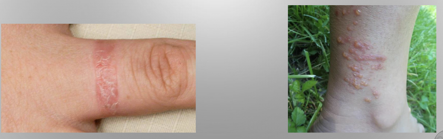<p>reaction of the skin most often r/t allergic immune response</p><p>cause: contact with allergen, specific cause not always known</p><p>symptoms: red papules and plaques, itching, area of irritation may take shape of causative agent </p><p>treatment: topical or oral corticosteroids, antihistamines, skin lubrication, cool, moist compresses, lukewarm colloidal oatmeal baths, elimination of contact allergen, avoid irritating affected area, if severe symptoms IV steroids may be needed </p>
