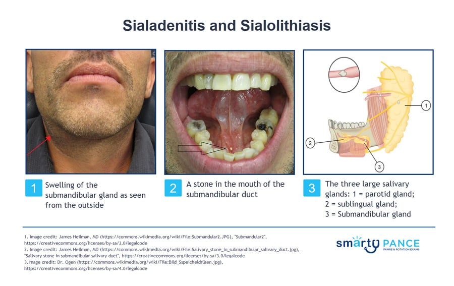 <p>Bacterial infection of a salivary gland usually caused by salivary stones</p><p>-Presentation: acute swelling of the cheek, which worsens with meals</p><p>-Dx: CT, US, MRI</p><p>-Tx: IV abx, hydration, warm compresses, gland massage</p>
