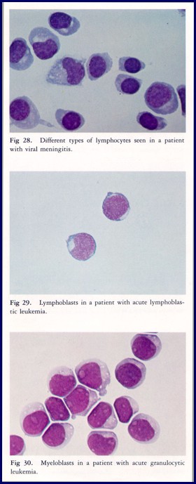 <ul><li><p>80% of ALL has CNS involvement</p></li><li><p>60% of AML has CNS involvment</p></li><li><p>leukemic cells including basophils may be present in CSF</p></li><li><p>Breast, lung, and other metastatic tumor cells</p></li></ul><p></p>