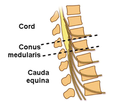 <ul><li><p><strong>Trauma affects the spinal cord at L1-L2</strong></p></li><li><p>Bowel/bladder dysfunction + saddle sensory loss</p></li></ul><p></p>