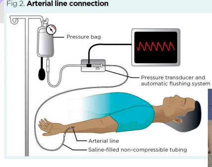 <p><span><span>Direct and continuous monitoring of systolic, diastolic, and MAP; source for repeated arterial blood gas</span></span></p>