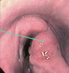 <p>What is this, causing arytenoid chondritis?</p>