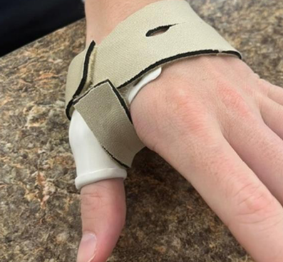<p>what type of splint is this?</p>