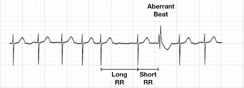 <ul><li><p>temporary, abnormal travel of an electrical impulse through the heart’s ventricles</p></li><li><p>occurs when an impulse arrives before the heart’s conduction pathways (specifically the bundle branches) have fully recovered from a previous beat</p><ul><li><p>causes a delay/block that results in a widened QRS complex</p></li></ul></li></ul><p></p>
