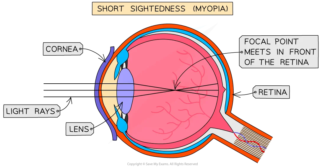 <ul><li><p>When the<strong> lens</strong> is the wrong shape and refracts the light <strong>too much</strong> or the <strong>eyeball</strong> is too l<strong>ong</strong>.</p></li><li><p>The images of distant objects are brought into focus in front of the retina. </p></li></ul><p></p>