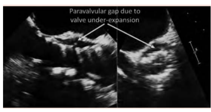 <p>Incomplete expansion of the TAVI valve because of calcium can result in</p><p>paravalvular and valvular regurgitation and higher valve gradient</p>