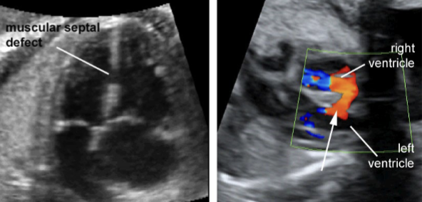 <ul><li><p><span style="color: red;">MC congenital heart lesion</span></p><ul><li><p>accounts for 30% of all structural heart defects</p></li></ul></li><li><p>accounts for 30% of all structural heart defects</p></li><li><p>abnormal opening in septum between <span style="color: red;">2 ventricles</span> of the heart</p><ul><li><p><span style="color: red;">isolated VSD is MC cardiac defect</span></p></li><li><p>appears as an area of discontinuity in interventricular septum </p></li></ul></li><li><p>membranous vs muscular</p></li><li><p>good prognosis</p><ul><li><p>spontaneous closure can occur in utero and within 1st year of life</p></li><li><p>large defects require surgical treatment </p></li></ul></li><li><p>4CH view is best to visualize large defects</p><ul><li><p>color Doppler can show the movements of flow between the ventricles </p></li></ul></li></ul><p></p>