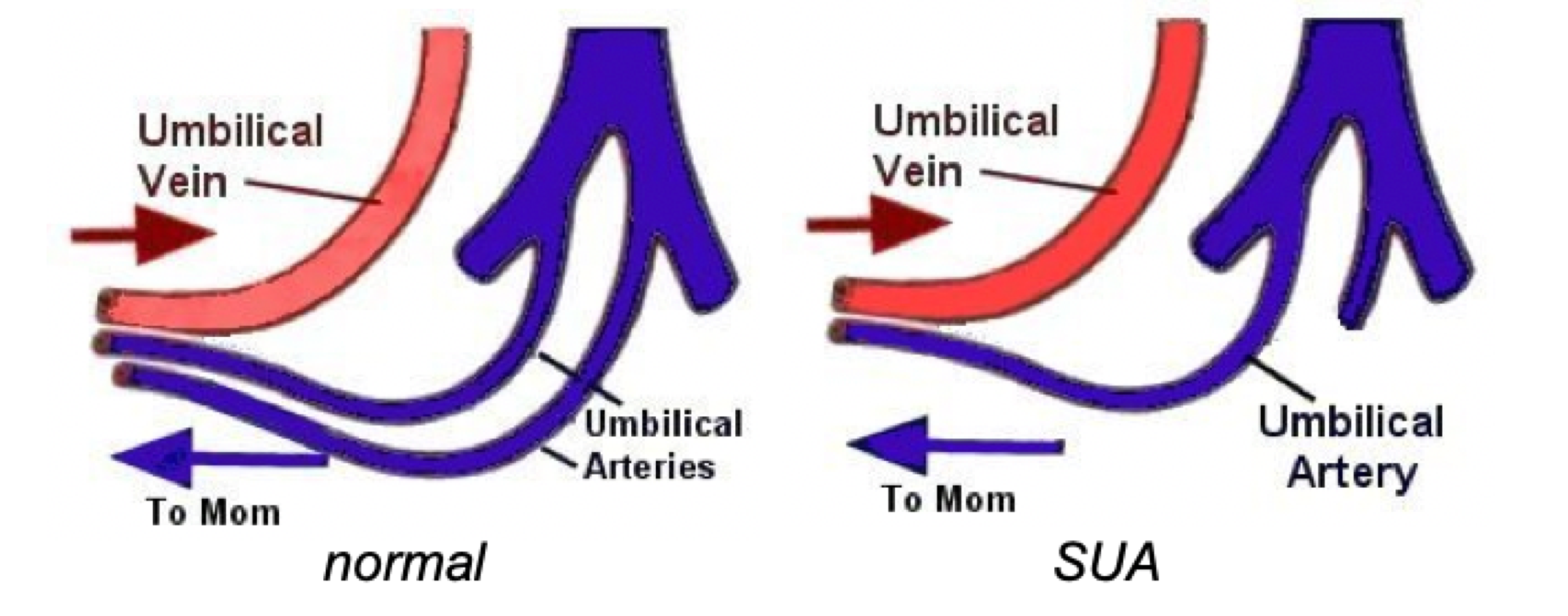 <ul><li><p>This is a disorder where a fetus has only one artery </p></li><li><p>Can occur together with Down Syndrome &amp; Failure of Kidneys </p></li></ul><p></p>