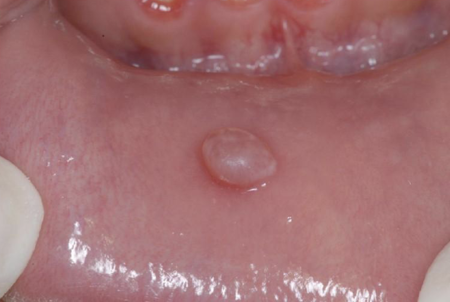 <p>Base of Lesion : flat base</p>