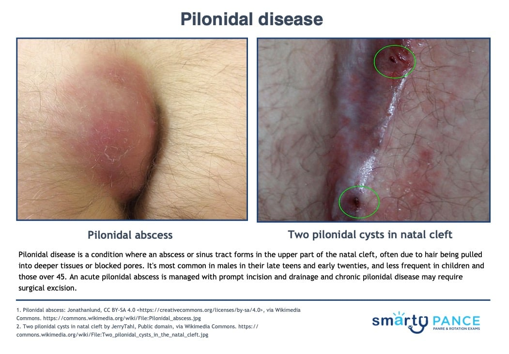 <p>A pit or cyst that traps hair and debris, becoming infected in the natal cleft </p><p>-RF: young men, obesity, sedentary jobs, deep natal cleft</p><p>-Presentation: midline pit with a secondary abscess or sinus tract and foul-smelling drainage </p><p>-Dx: clinical </p><p>-Tx: I&amp;D + abx if cellulitis </p>