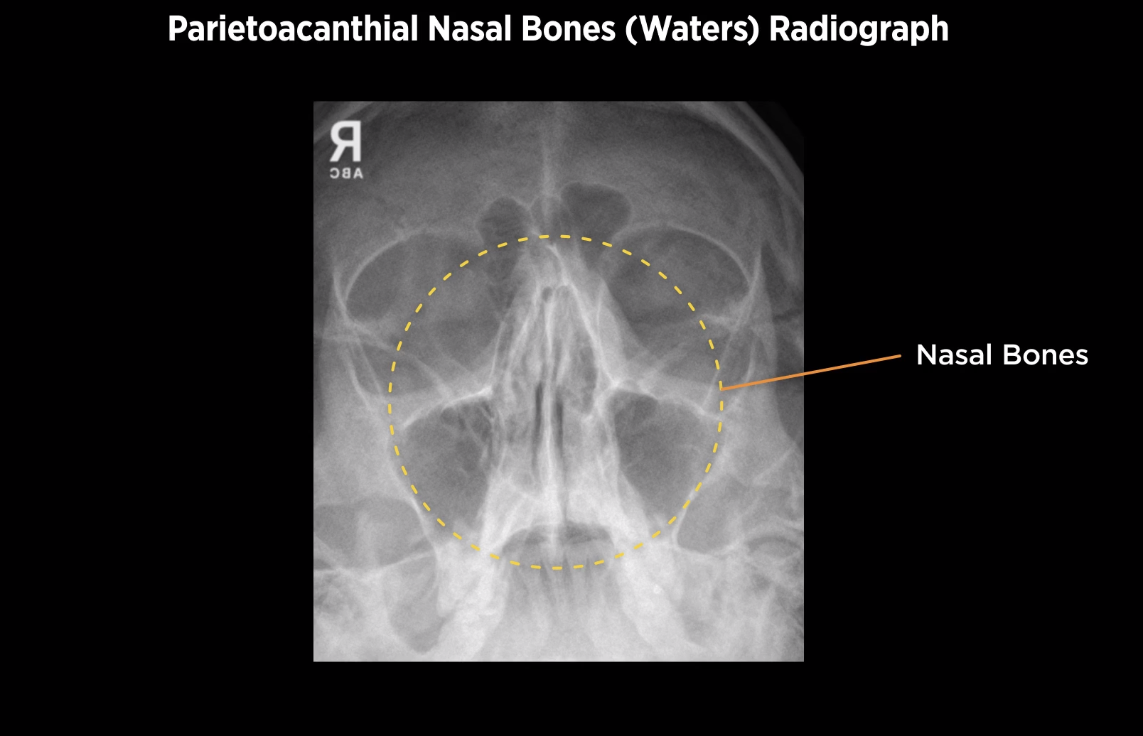 <p>Parietoacanthial waters nasal view </p>