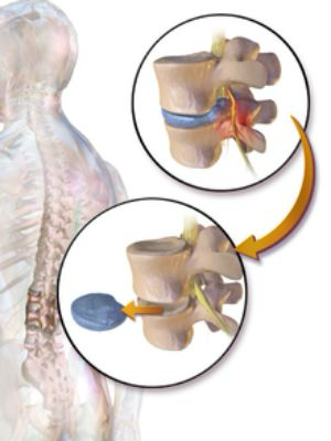 <p>Disc removal</p>