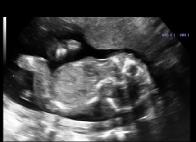 <p>iniencephaly (cause is unknown)</p>
