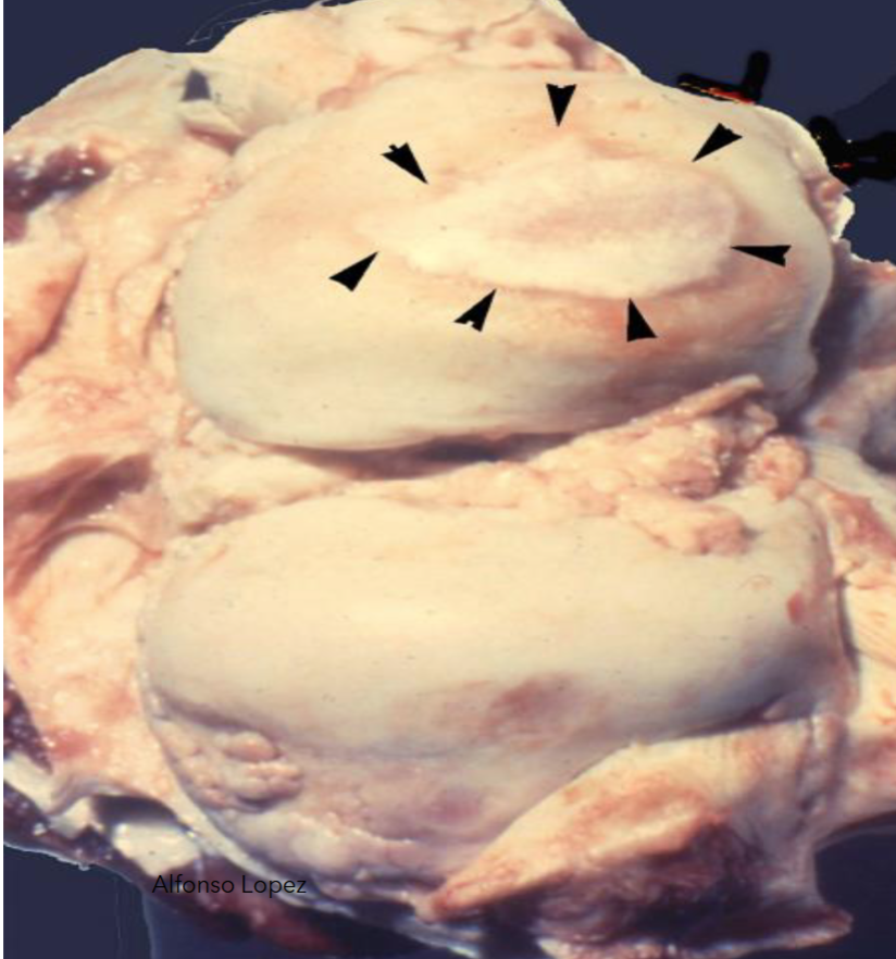 <p>what is this and how it it caused </p>