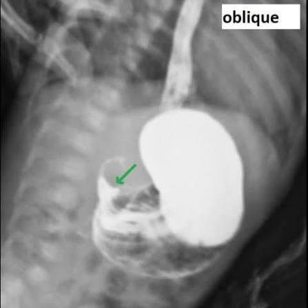 <p>Pt presents usually male, </p><p>2-8 weeks </p><p> was normal but now projectile vomiting. </p><p>Olive shaped mass, peristaltic waves.</p>
