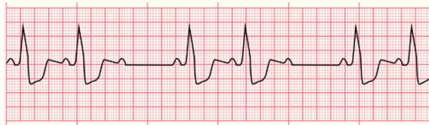 <p>the PR intervals stays the same but, “some P waves” don’t conduct to QRS</p>