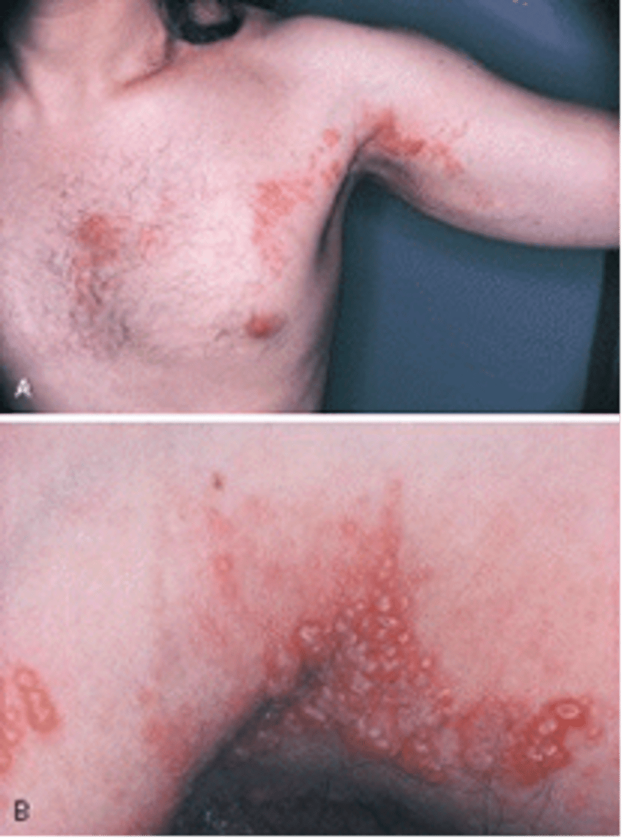 <p><br>viral infection producing the eruption of highly painful vesicles that may follow a nerve path</p><p><br><span>The unilateral eruption of vesicles along the distribution of a sensory nerve seen in this adult patient is called?</span></p>