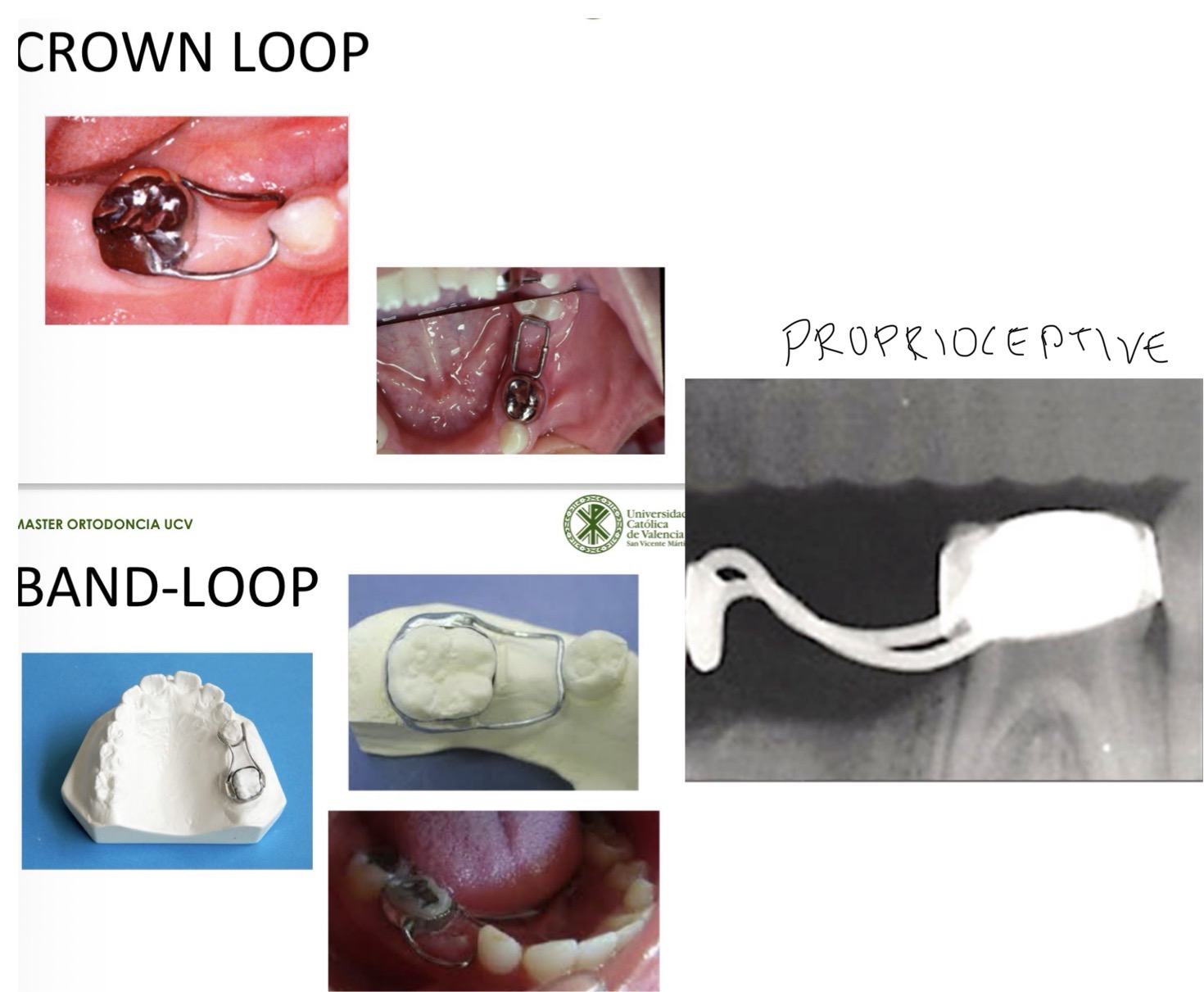 <p>Crown loop</p><p>Band loop- never for more than 1 absence </p><p>Proprioceptive</p>