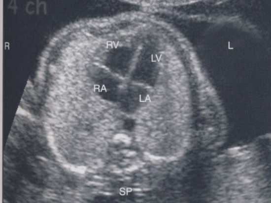 <ul><li><p><span style="color: red;">normal heart position</span></p></li><li><p>apex of heart points to left and bulk of the heart is in the left chest</p></li><li><p>denotes both normal position of heart in left chest</p></li></ul><p></p>