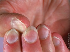 <p>What is this called? What two diseases is it MC a/w?</p>
