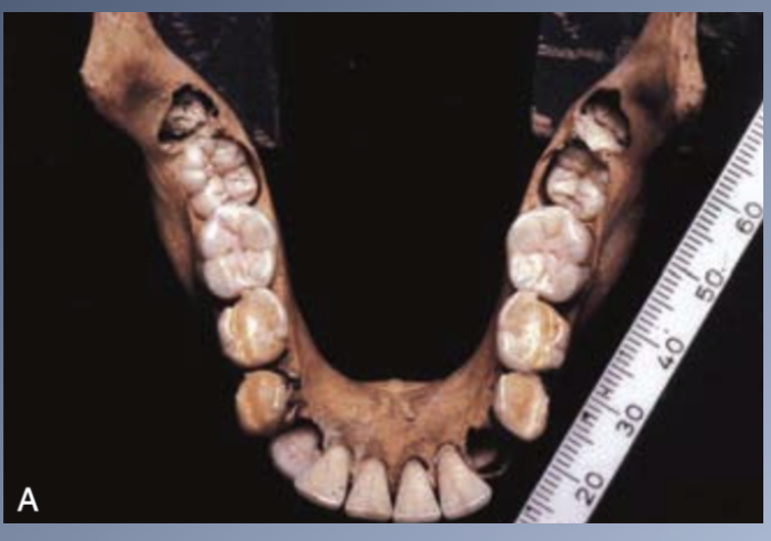 <p>MATURATIONAL AND AGING CHANGES- <span>LACK OF “NORMAL ATTRITION” IN THE MODERN DIET</span></p>