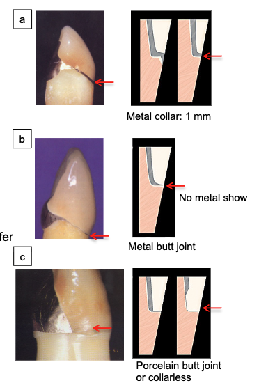 <ol><li><p>Metal collar</p></li><li><p>Metal butt joint</p></li><li><p>Porcelain butt joint or collarless</p></li></ol><p></p>