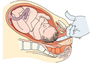 <p>If FHR variability is depressed during labor, <mark data-color="purple" style="background-color: purple; color: inherit;">this helps assess welfare of the fetus</mark></p><ul><li><p>Stim baby scalp w finger (through dilated cervix)</p></li><li><p>baby should have momentary inc FHR</p><ul><li><p>if in distress, FHR acceleration will NOT occur</p></li></ul></li></ul><p></p>