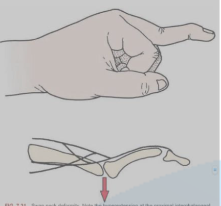 <p>Swan Neck Deformity</p>