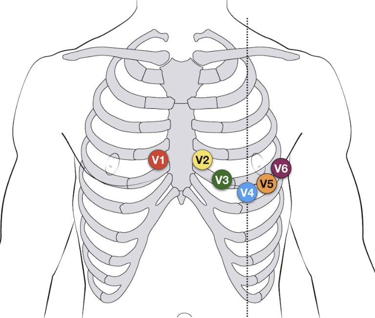 <p>V1 = 4th ICS, RIGHT sternal border</p><p>V2 = 4th ICS, LEFT sternal border</p><p>V3 = between V2 and V4</p><p>V4 = 5th ICS, midclavicular line</p><p>V5 = anterior axillary line, level with V4</p><p>V6 = midaxillary line, level with V4</p>