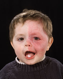 <p>findings consistent w neuro condition newborn</p>