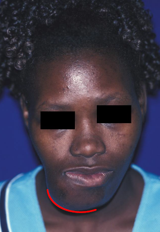 <p>characteristic of ossifying fibroma</p>