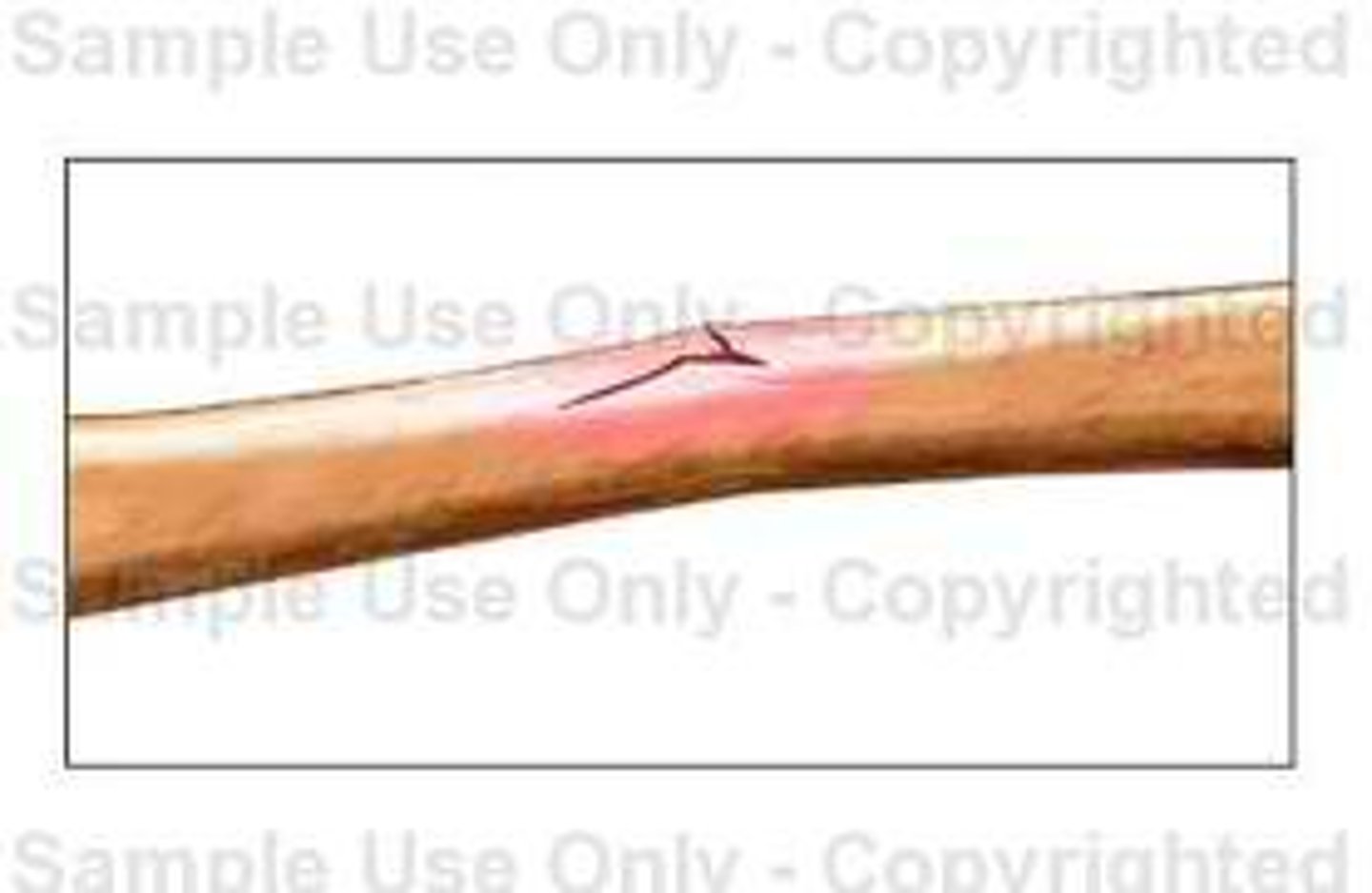 <p>bone splinters, happens in children, not a clean break</p>