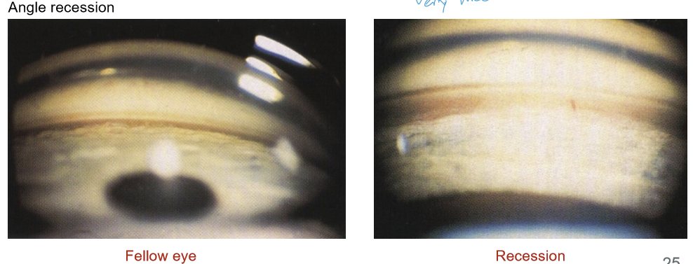 <p>Angle recession is a tear between the longitudinal and circular fibers of the ciliary body following blunt trauma. Microtears alter normal aqueous drainage pathways and can result in decreased aqueous outflow and subsequent glaucoma.</p>