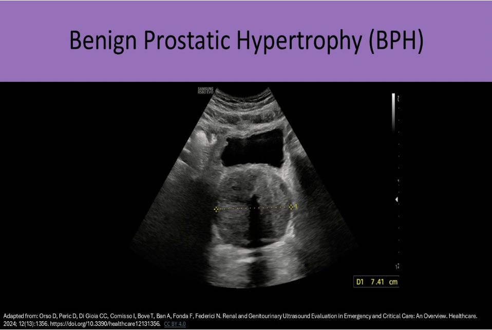 <p>B. benign prostatic hypertrophy</p><p class="p1">BPH occurs in the transitional zone. Carcinoma and prostatitis most commonly occur in the peripheral zone. BPH causes increased levels of PSA in the blood. Carcinoma also causes increased PSA (>10ng/ml) but usually much more significantly than BPH.</p>