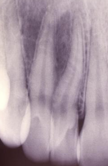 <p>2 teeth joined </p>