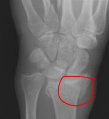 <p>collapse of one fragment of bone into another</p>