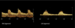 <p>a Doppler ultrasound finding indicating significant arterial narrowing proximal to the measurement site. It is characterized by a slow, delayed systolic upstroke ("tardus") and a diminished, rounded systolic peak ("parvus").</p>