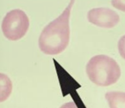 <p>dacrocytes or teardrop cells</p>